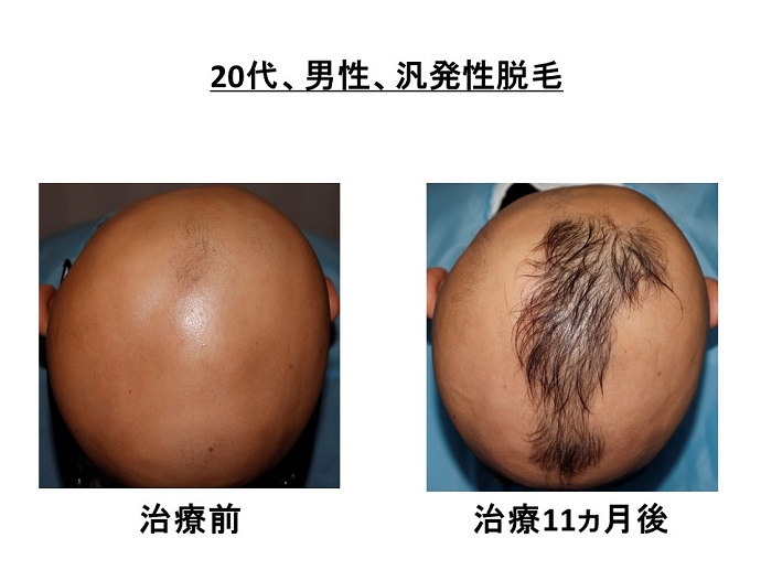 円形脱毛症　病院